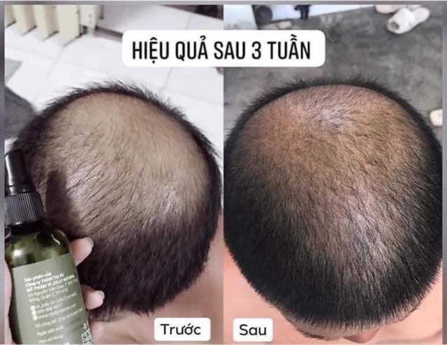 [[CHÍNH HÃNG]] Xịt bưởi mọc tóc Vijully