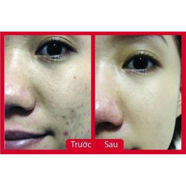 mờ sẹo thâm Scar Esthetique 10g date mới