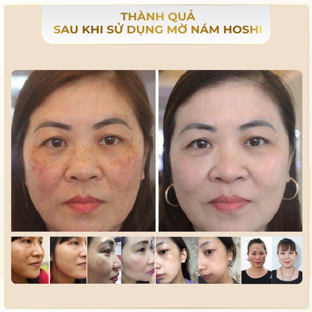 Kem dưỡng da Hoshi Công nghệ Nhật Bản - Tái tạo trẻ hoá làn da, Chống lão hoá, Mờ thâm nám, Tàn nhang