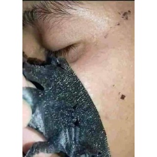 lột mụn đầu đen