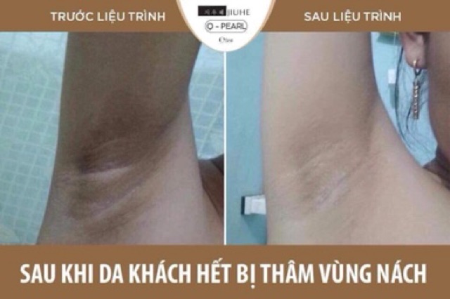 SERUM JIUHE THÂM CHÍNH HÃNG THANH TÔ 100% | BigBuy360 - bigbuy360.vn