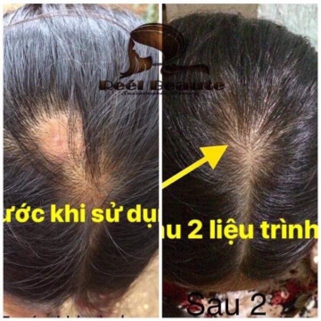 Túi lọc dầu gôi phổ thông cải tiến, nguồn gốc thảo dược từ thiên nhiên REEL BEAUTE ( loại cao cấp)