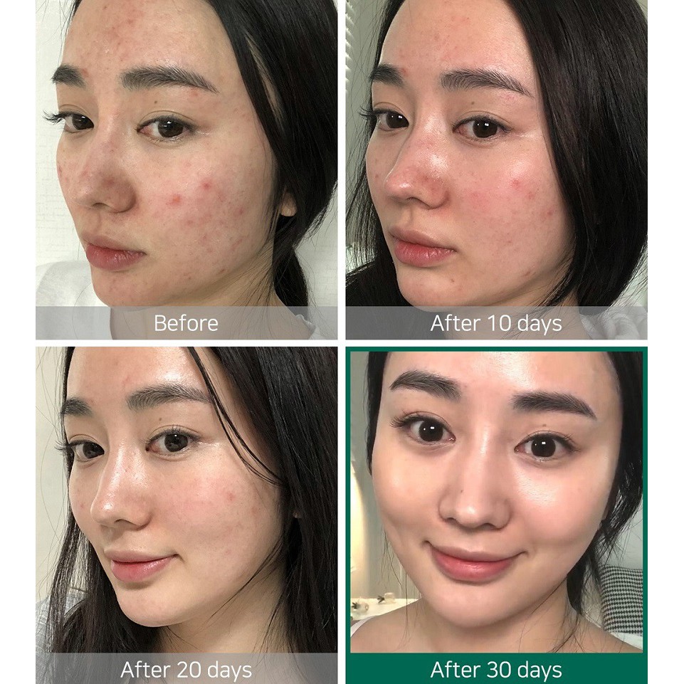 Nước Hoa Hồng SOME BY MI AHA-BHA-PHA/SNAIL/YUJA/Matcha Giảm Mụn,Mờ Thẹo,Se khít Lỗ Chân Lông,DưỡngẨm,Sáng Da (135/150ML) | BigBuy360 - bigbuy360.vn