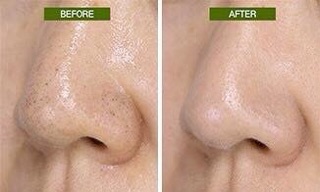 Thanh lăn mụn MAMONDE