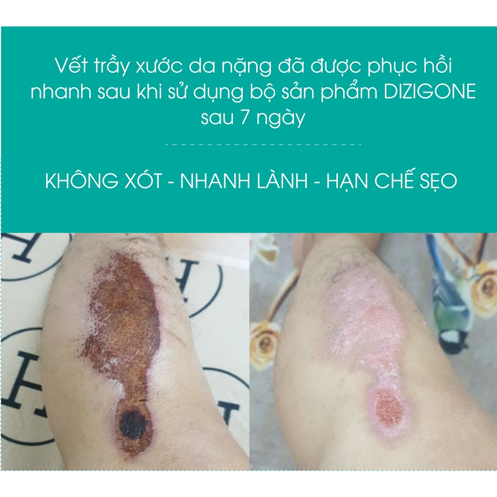 Kem Bôi Dizigone Nano Bạc 25g - Kháng Khuẩn, Lành Vết Thương, Tái Tạo Da, Ngăn Ngừa Sẹo