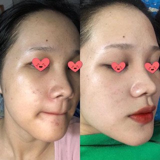 Kem Mụn Victoria