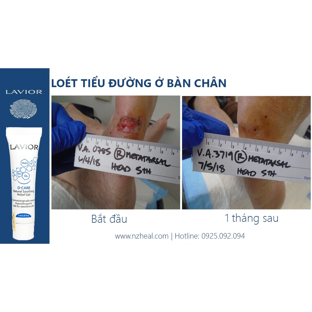 [Hỏa tốc] Lavior Diabetic Wound Gel 7ml - Làm lành vết thương, vết loét tì đè, loét chân tiểu đường, trầy xước da, bỏng