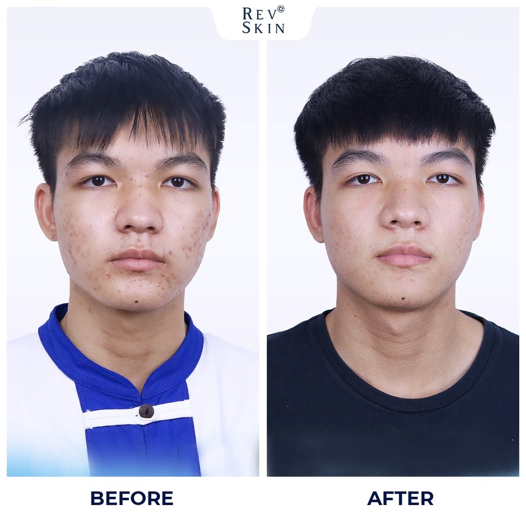 [DƯỢC MỸ PHẨM] Chấm Mụn Giảm Mụn, Giảm Thâm, Sẹo Rỗ RevSkin Acne Cực Kỳ Hiệu Qủa