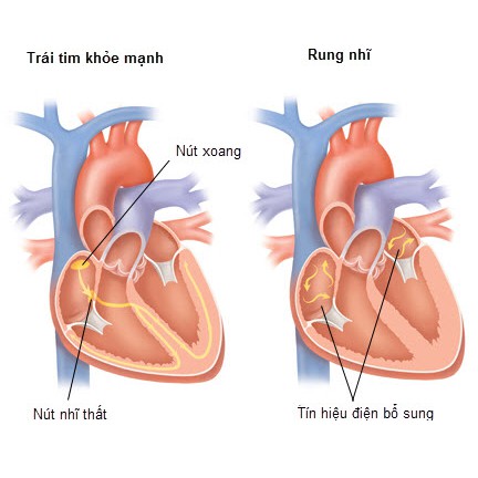 Máy đo huyết áp MICROLIFE BP A6 BT,công nghệ AFIB với khả năng phát hiện sớm rung nhĩ