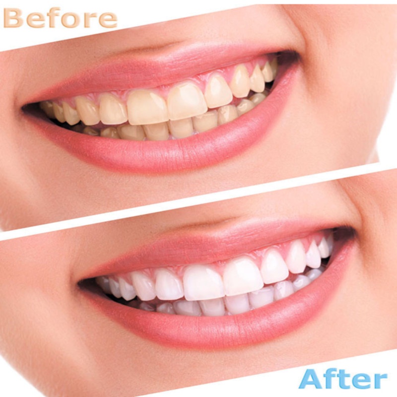 Bộ 10 Gel Làm Trắng Răng 44% Peroxide/Oral Chuyên Nghiệp