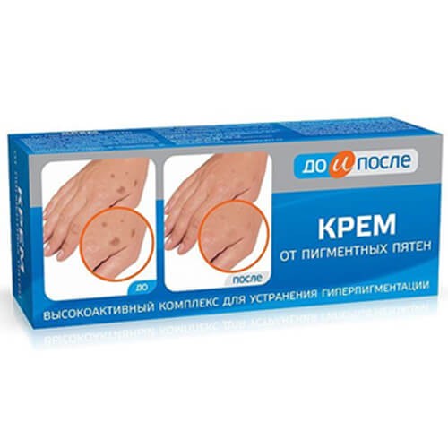 Kem xoá đồi mồi Nga - Kem đồi mồi