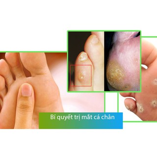 Miếng dán trị mụn cóc