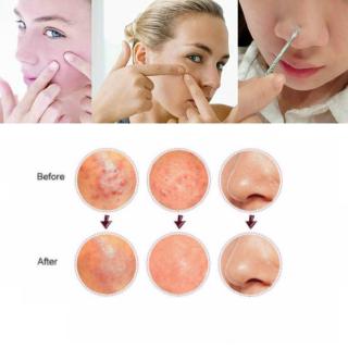 1 Cây Nặn Mụn Đầu Đen