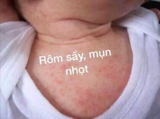 Mỡ trăn