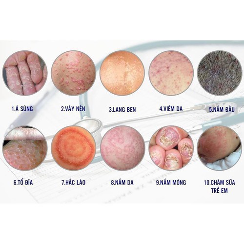 Kem Bôi Hắc Lào, Nấm Ngứa, Tổ Đỉa, Lang Ben, Vảy Nến, Á sừng, Các Vấn Đề Về Da - Hàng Nội Địa Trung ( V ) | BigBuy360 - bigbuy360.vn
