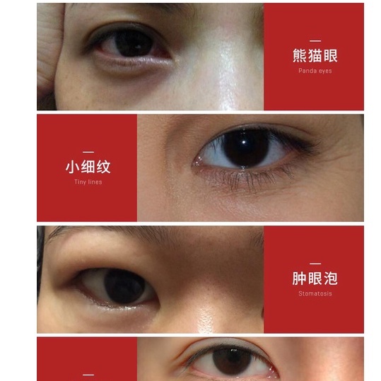 MẶT NẠ MẮT ARBUTIN SÁNG DA VÙNG MẮT NGỪA NẾP NHĂN DƯỠNG THƯ GIÃN MẮT