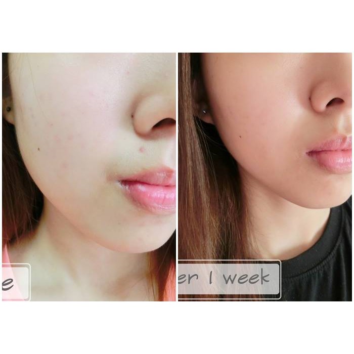 Gel Làm Mờ Sẹo Và Thâm Mụn Hiruscar Post Acne 5g