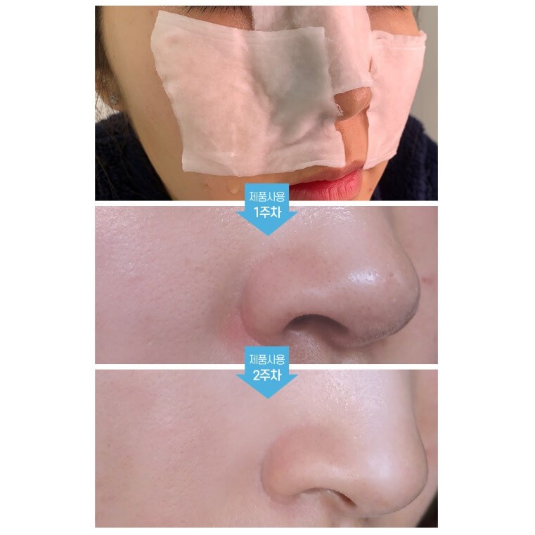 [Chính Hãng] Dung Dịch Ủ Mụn Đầu Đen Medi-peel Extra Super 9 Hàn Quốc | BigBuy360 - bigbuy360.vn