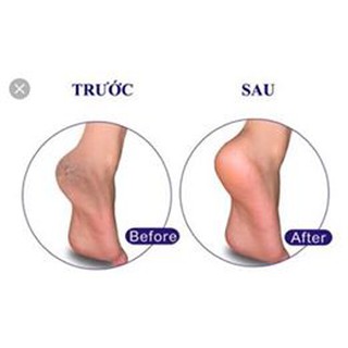 Kem trị nứt gót chân BA Thái Lan (sáp nẻ BA)