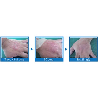 BĂNG SILICON LIỀN SẸO (POLY SCARFREE)