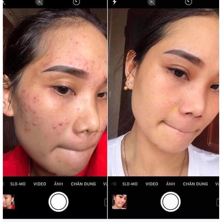 Combo serum bột khổ qua mướp đắng Lim sạch mụn mờ thâm nám an toàn hiệu quả | BigBuy360 - bigbuy360.vn