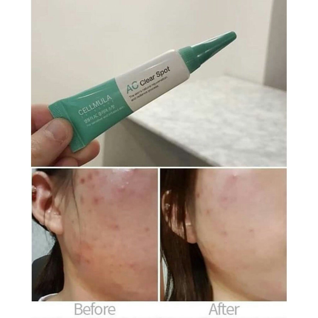 Kem Ngừa Mụn AC CLEAR SPOT CELLMULA - Tuýp 10ml - Sạch Mụn, Giảm Thâm Trắng Da Từ Thảo Dược Dùng Cho Mọi Loại Da