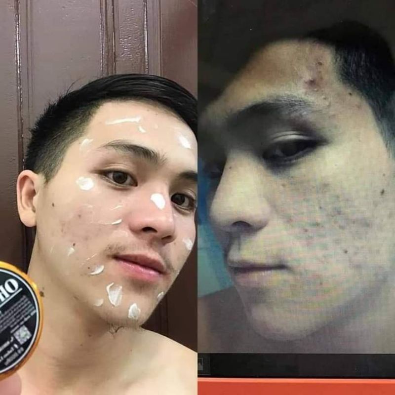 KEM OHO cream ☺ giảm mụn, thâm, sẹo 15g.