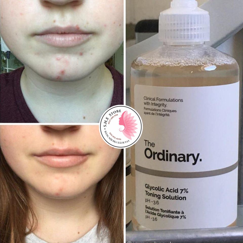 Toner Solution The Ordinary Glycolic Acid