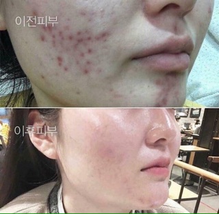 RED PEEL TINGLE SERUM