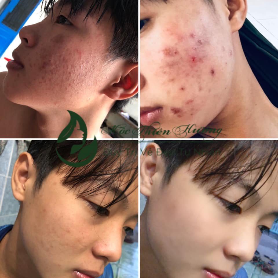 Serum giảm mụn thâm rỗ, sáng da, se khít lỗ chân lông Mộc Thiên Hương | BigBuy360 - bigbuy360.vn