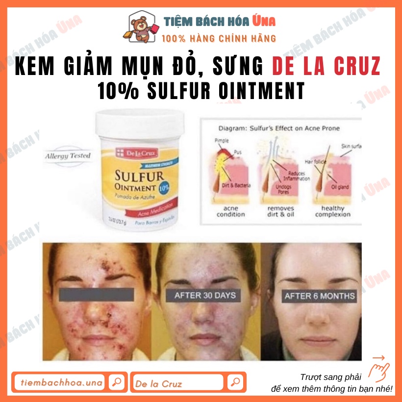 Kem giảm mụn lưu huỳnh De La Cruz Sulfur Ointment Acne Medication Maximum Strength chấm mụn bọc, mủ, trứng cá