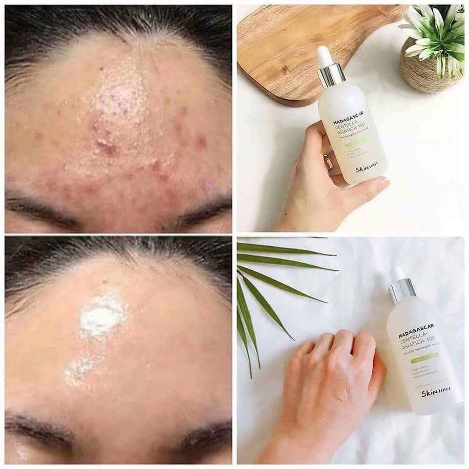 Tinh Chất Rau Má Da Nhạy Cảm Skin1004 Madagascar 55ml