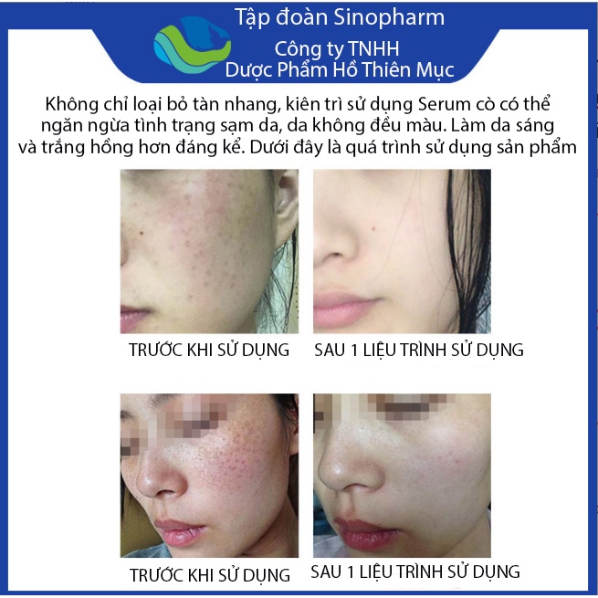 Serum Dưỡng Da FOEO, Loại Bỏ Nám, Mụn, Tàn Nhang, Sạm Da, Da Không Đều Màu, Giúp Cho Da Trắng Sáng, Mịn Màng