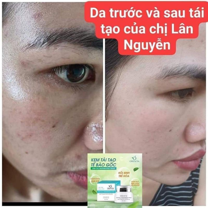 Kem Tái Tạo Tế Bào Gốc – Stem Cell Regenerating - ORENYA