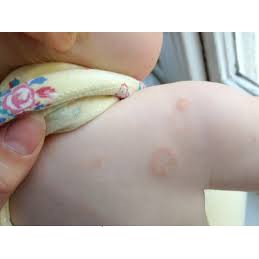 ✅ Kem bôi nấm ngứa, tổ đỉa, hắc lào, lang ben, vảy nến, á sừng,viem da các vấn đề da liễu lâu năm | BigBuy360 - bigbuy360.vn