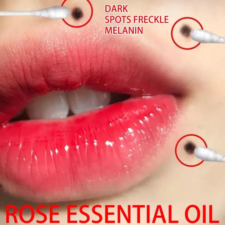 Tẩy xoá nốt ruồi, tàn nhang, mụn cóc, mụn thịt, mắt cá，20ml