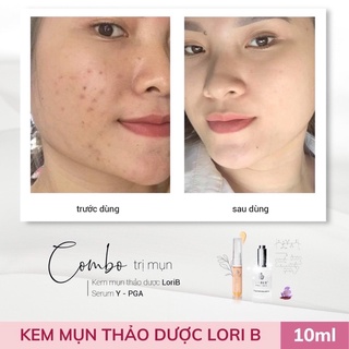 kem mụn LoriB [hàng chính hãng công ty] Date mới