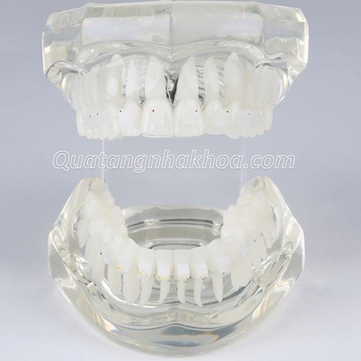 Mẫu hàm tư vấn chỉnh nha mắc cài sứ – mô hình nắn chỉnh răng nha khoa