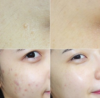 TINH DẦU TRÀM TRÀ CHẤM MỤN A’PIEU NONCO TEA TREE OIL