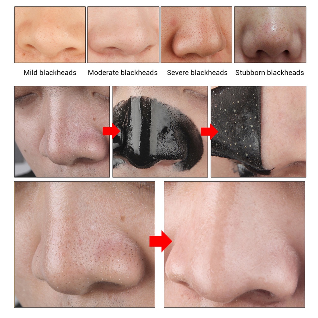 Mặt Nạ Hỗ Trợ Giảm Mụn Đầu Đen Làm Sạch Sâu Se Khít Lỗ Chân Lông Dành Cho Unisex