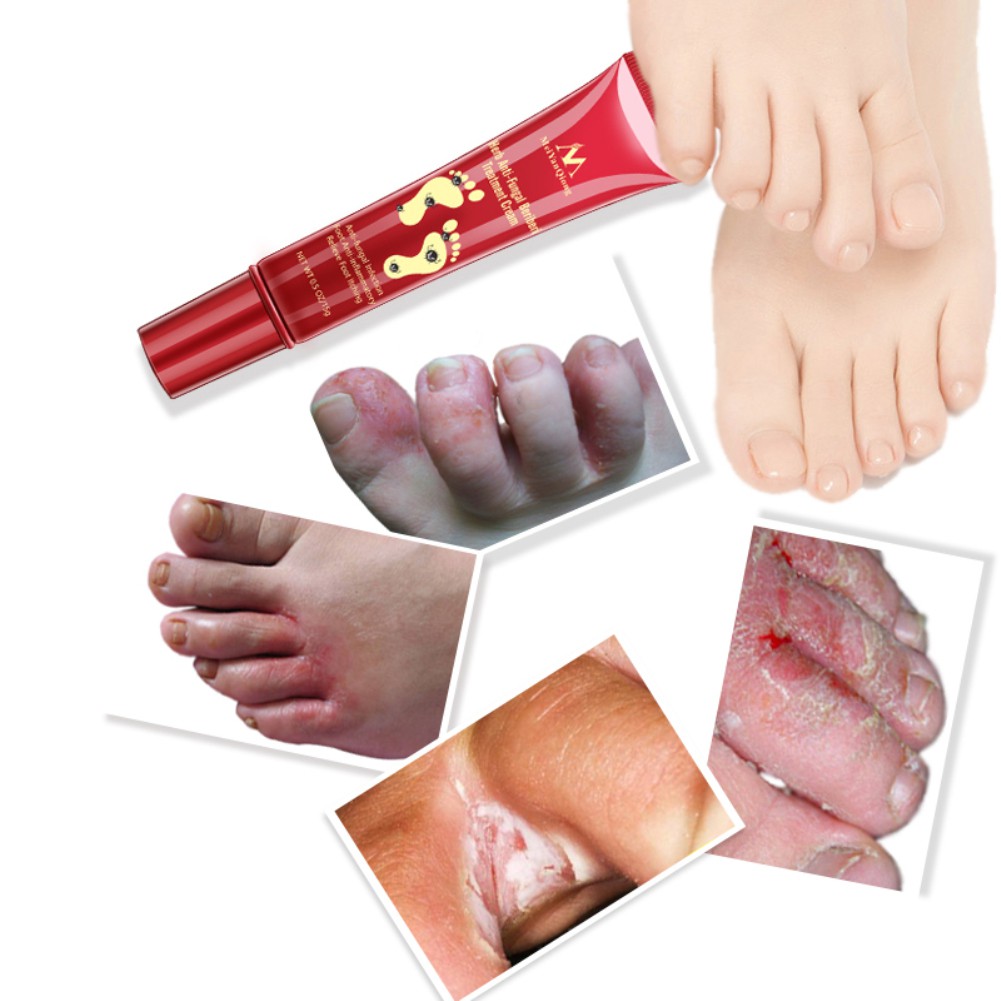 Thuốc mỡ hỗ trợ giảm bệnh nấm móng chân và ngứa | BigBuy360 - bigbuy360.vn