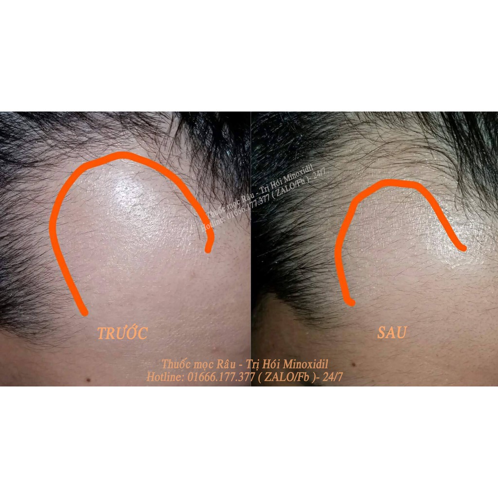 COMBO Thuốc mọc Râu Tóc Minoxidil 5% + Dầu dưỡng Beard Oil 10ml giúp Râu tóc mọc nhanh khỏe giữ ẩm da.