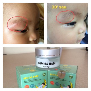 Kem Sả Babi cho trẻ nhỏ