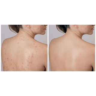 [ 𝐒𝐢̉ 𝐇𝐂𝐌 ] Dung Dịch Xịt Mụn Lưng Vitara Thái Lan 50ml
