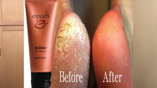 KEM TRỊ NỨT GÓT CHÂN SOLE SOLUTION FOOT TREATMENT