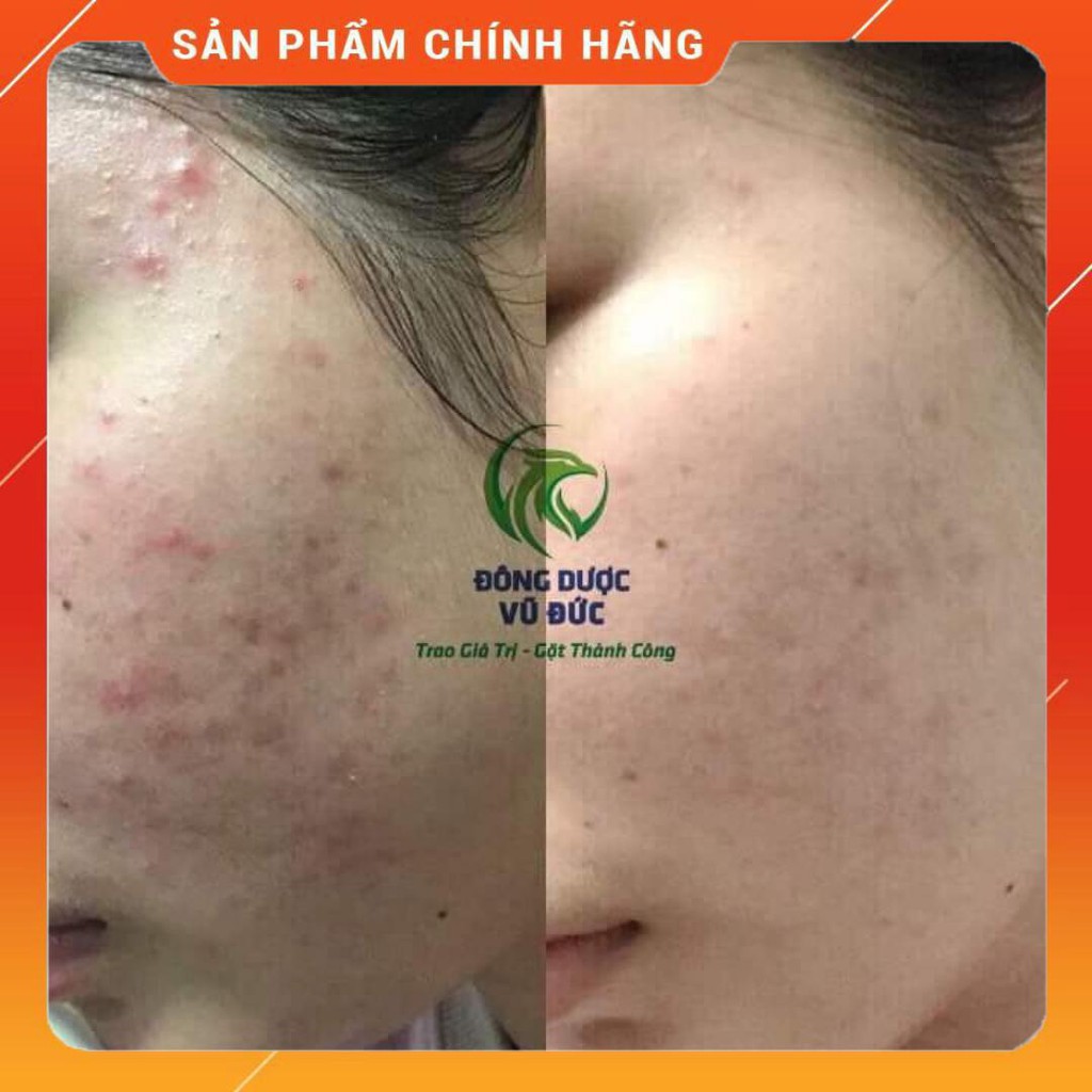 Huyết Hồng Sâm - Thảo Dược Điều Trị Mụn, Mụn Bọc, Mụn Mủ, Mụn Trứng Cá, Mụn ẩn, Mụn Đầu Đen | BigBuy360 - bigbuy360.vn