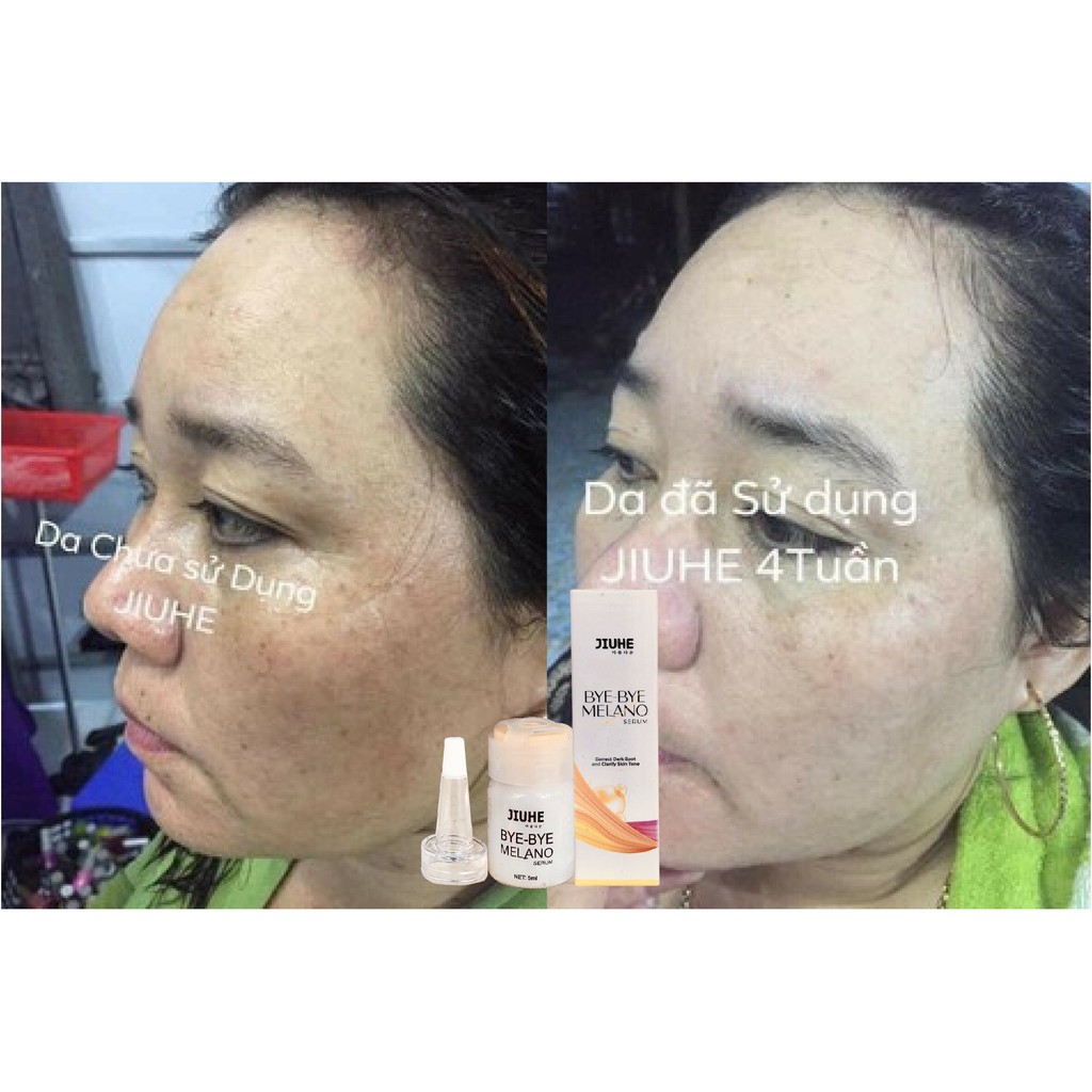 Serum tri thâm hàn quốc JIUHE Q-PEARL giảm thâm do mụn khửu tay chân, thâm sẹo, thâm nách hiệu quả | BigBuy360 - bigbuy360.vn