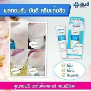 Kem Tri Mụn Yan Hee
