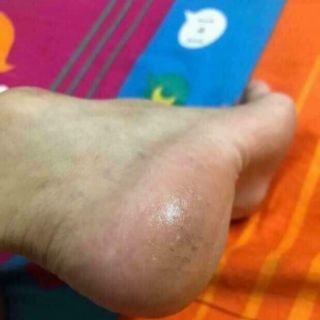 KEM TRỊ NỨT GÓT CHÂN CHUỐI