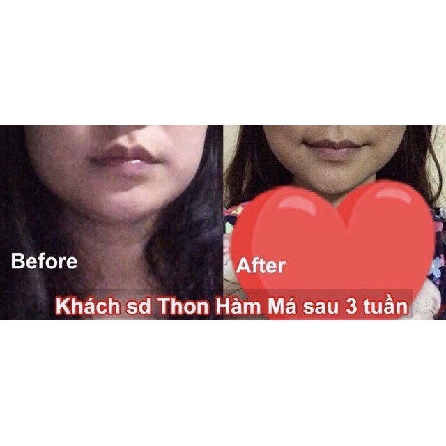 Tinh chất thu xương hàm má Miracle - Pháp, hiệu quả chỉ sau 14 ngày (10ml)